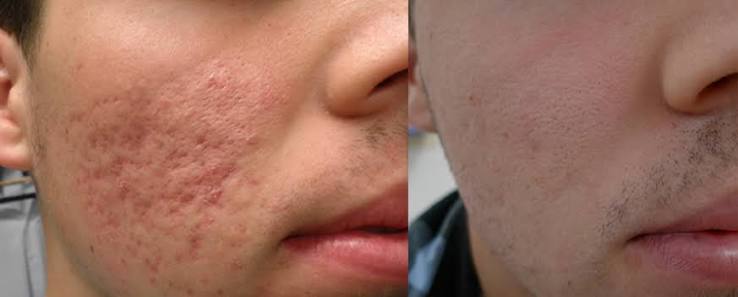 How Skin Type Impacts the Choice of Scar Removal Procedure